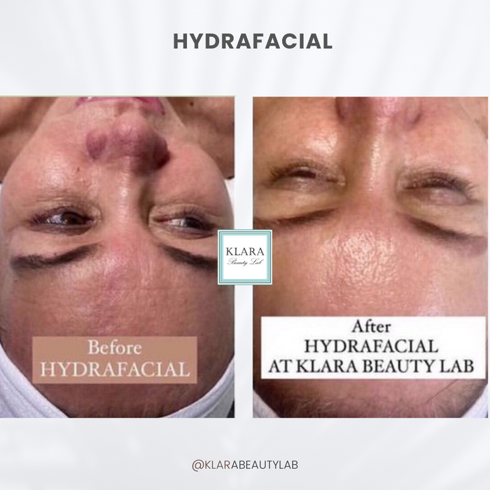 HYDRAFACIAL