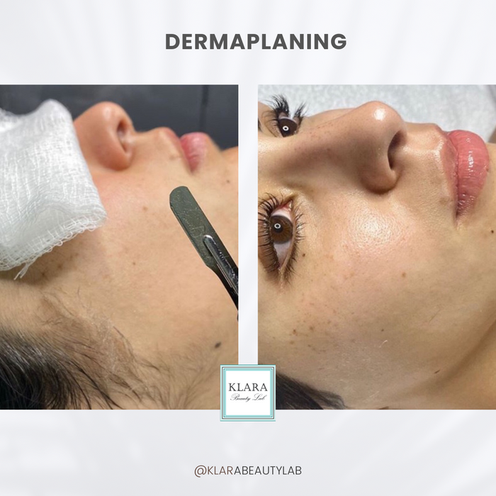 DERMAPLANING