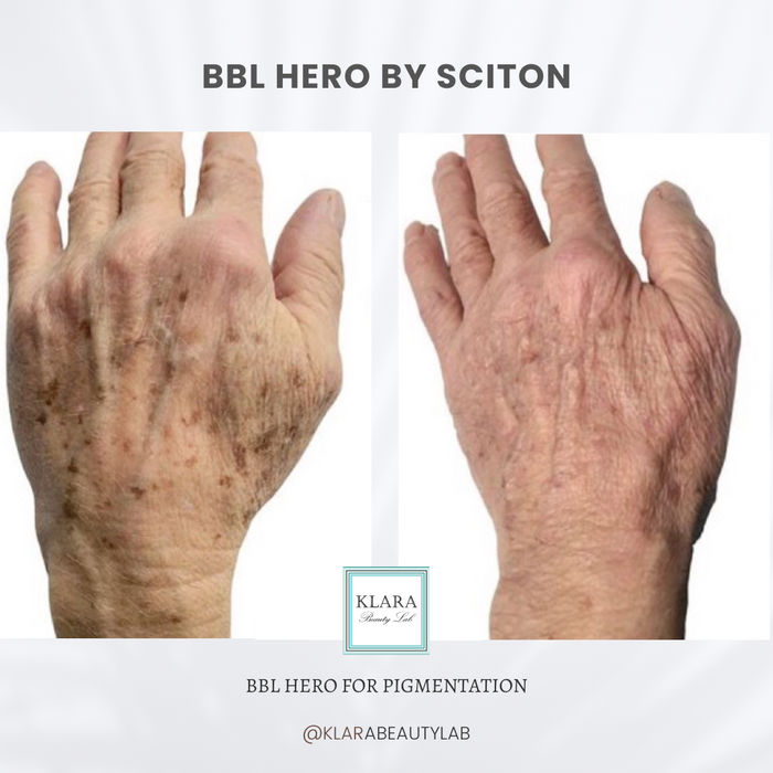 BBL BY SCITON (BODY)