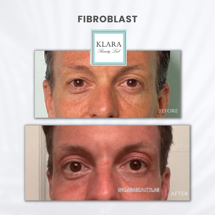 FIBROBLAST
