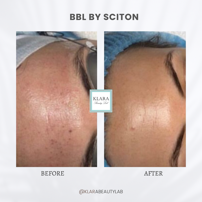 BBL BY SCITON (FACE)