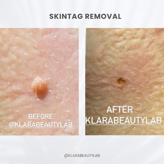SKINTAG REMOVAL