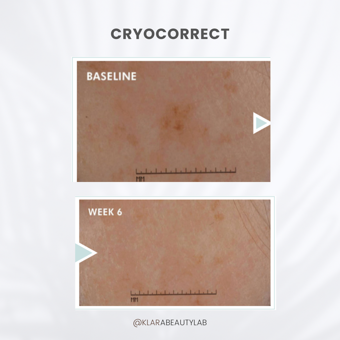 CRYOCORRECT