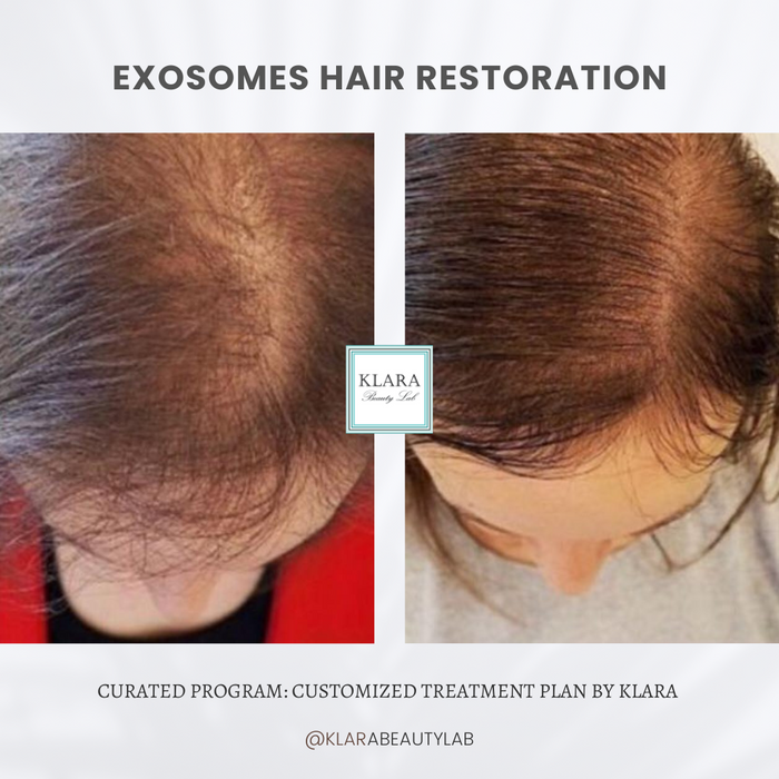 EXOSOMES HAIR RESTORATION