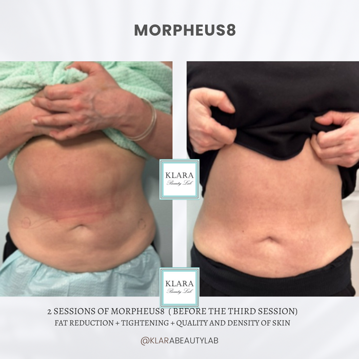 MORPHEUS8 (BODY)