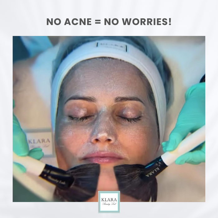 NO ACNE = NO WORRIES!