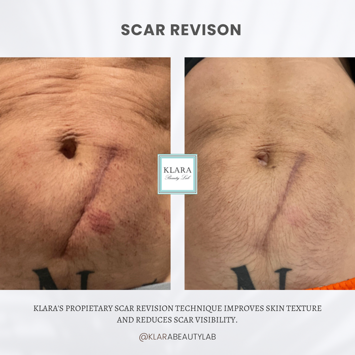 SCAR REVISION